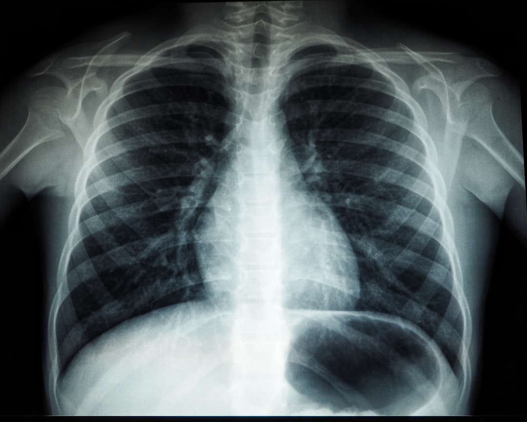 A chest X-ray showing the lungs and thoracic cavity, the physical system that smart rings observe only through cardiac proxy